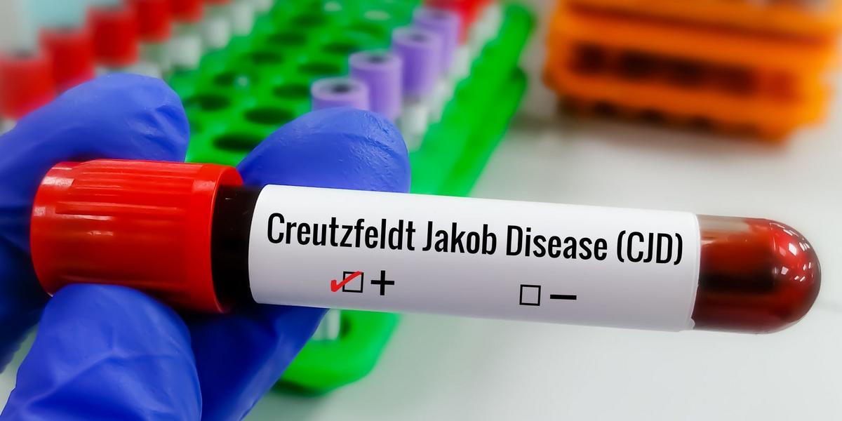 Entenda a Doença de Creutzfeldt-Jakob: O raro quadro neurológico que afeta o piloto Lito Souza 1 adobestock 775081401