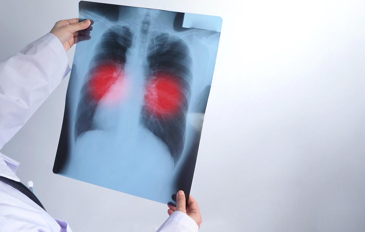 Amazonas registra queda de quase 15% nas mortes por tuberculose em 2026 1 foto 2 materia