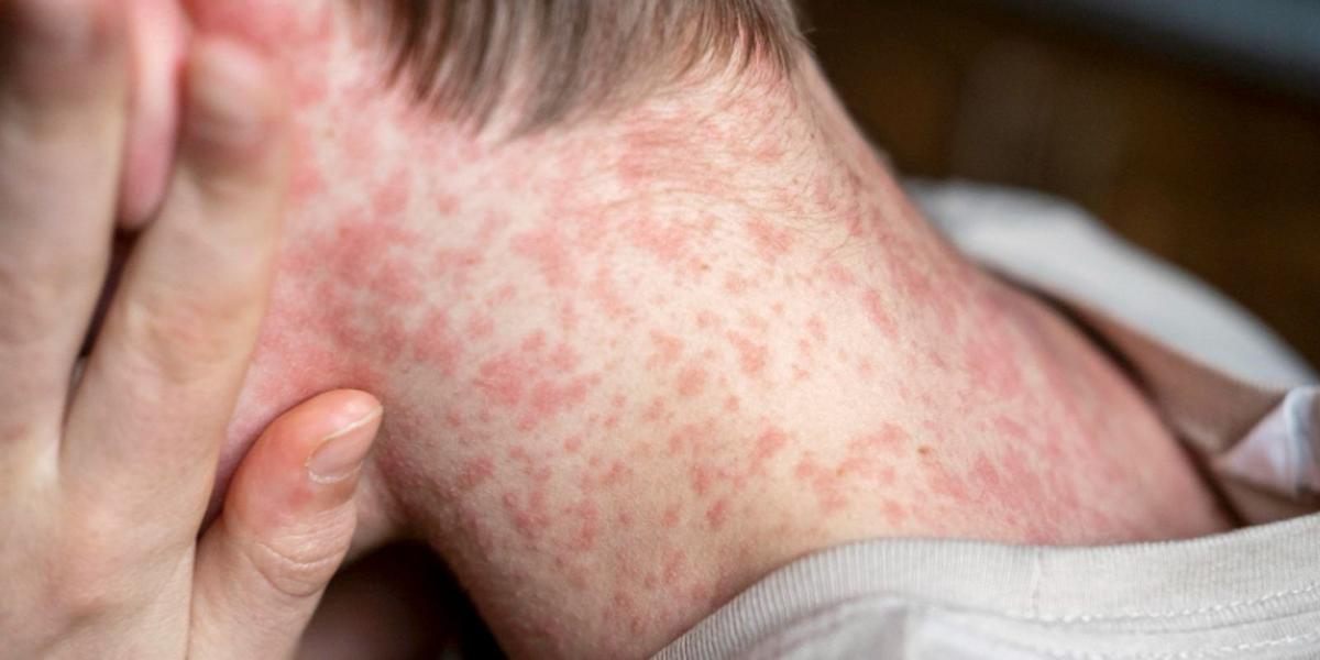 Sarampo em alerta: São Paulo registra 28 casos e reforça importância da vacina 1 2ghe0jojcnd7rmldmlwh9jcdcmaymfpdahtumjez