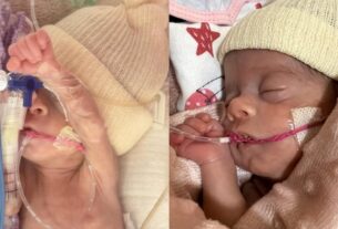 antes e depois de bebe que chegou a pesar 620 gramas supera fase critica apos mais de 60 dias na uti neonatal no am