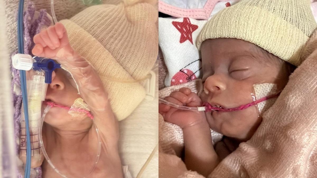 antes e depois de bebe que chegou a pesar 620 gramas supera fase critica apos mais de 60 dias na uti neonatal no am