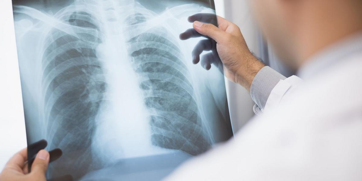 Anvisa libera novos medicamentos de ponta para tratamento de câncer de pulmão e mama 1 adobestock 456314415